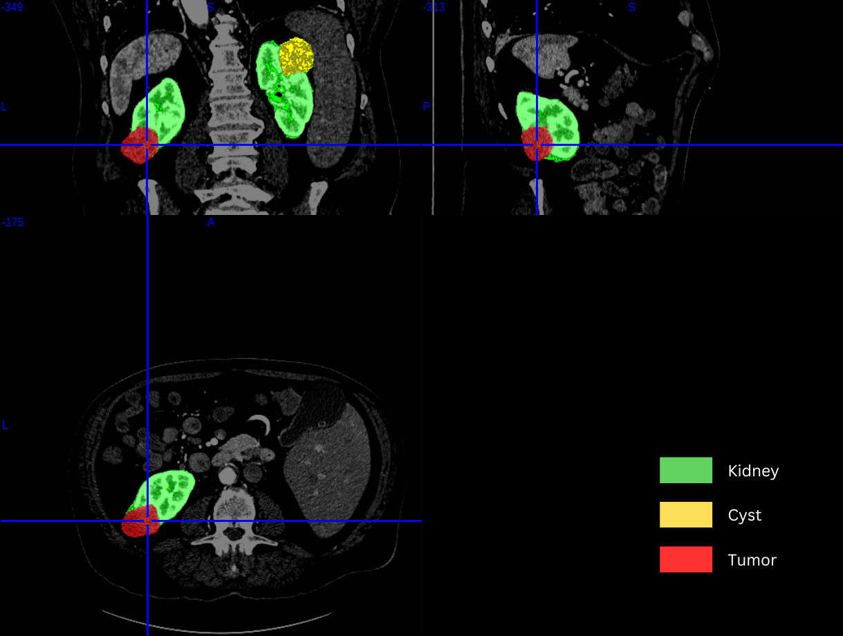 kidney_tumor_seg_sample.png